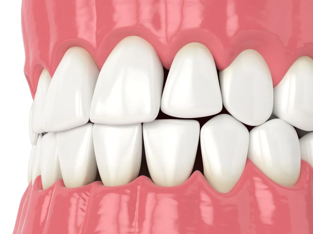 Black trinagles between teeth 3d render showing gaps