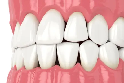 Black Triangles Between Your Teeth
