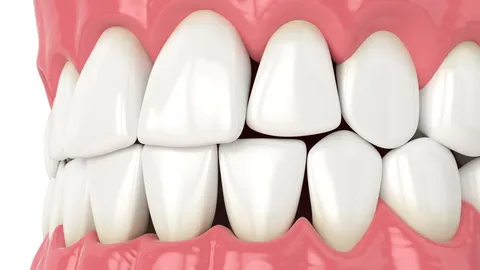 Black Triangles Between Your Teeth