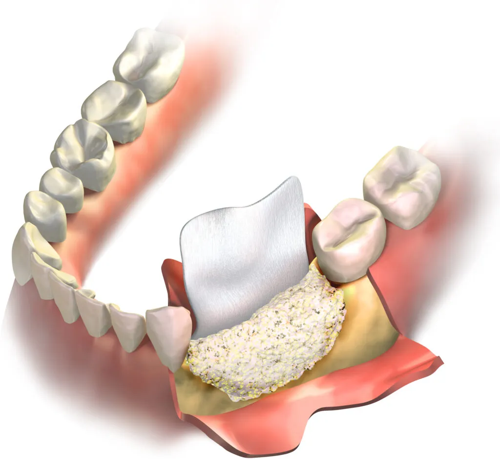 Bone grafting on lower jaw 3d illustration