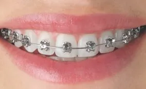 Braces