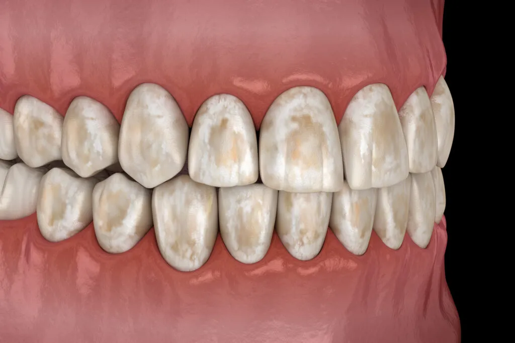 Brown Stain on teeth 3D Render