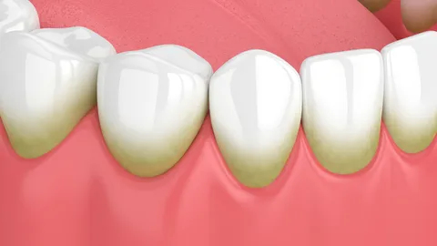 What to Expect During Teeth Whitening⁠—Experts Weigh In