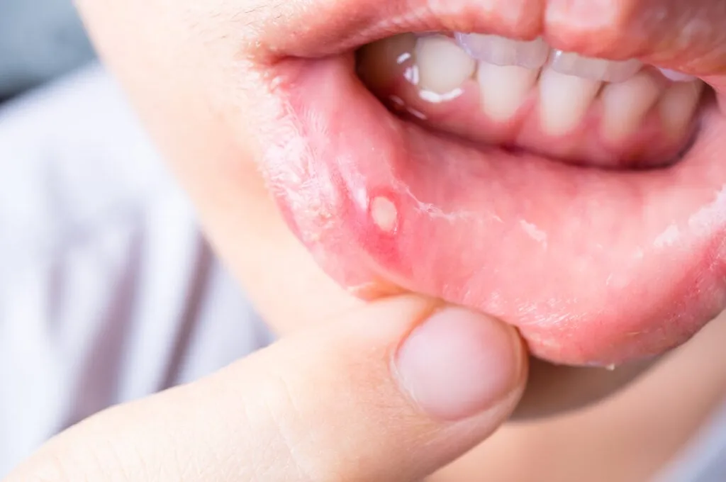 Close-up of a person's lower lip showing a white sore or ulcer on the inner lip, with a finger gently pulling the lip down for visibility.