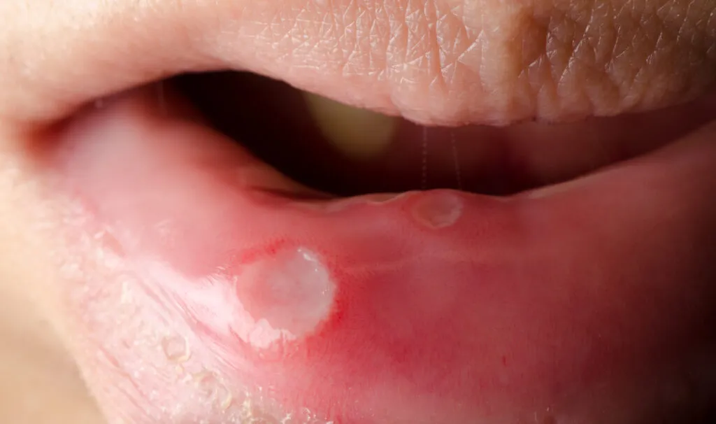 Close-up of a person's lower lip showing a round, white canker sore with red inflammation around it.