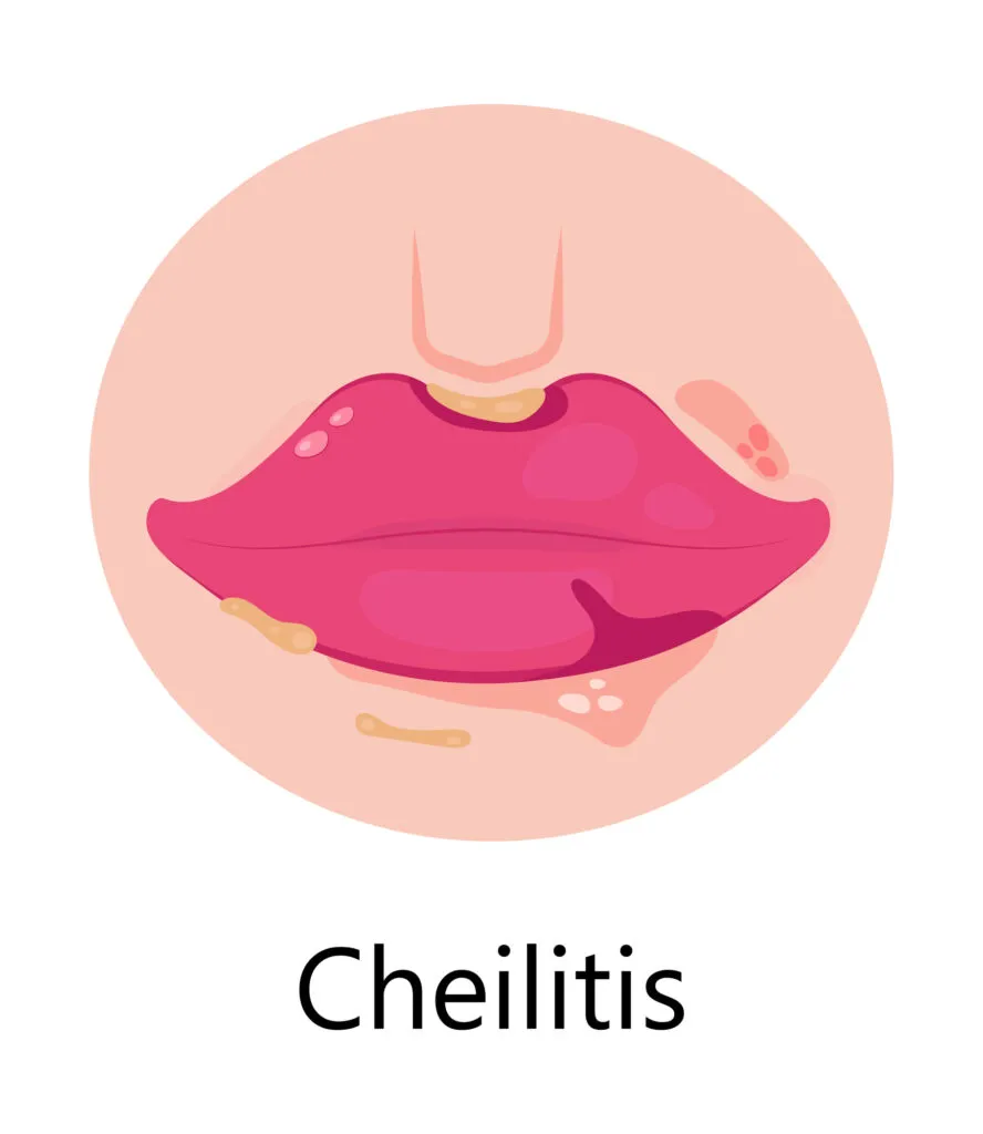 Cheilitis