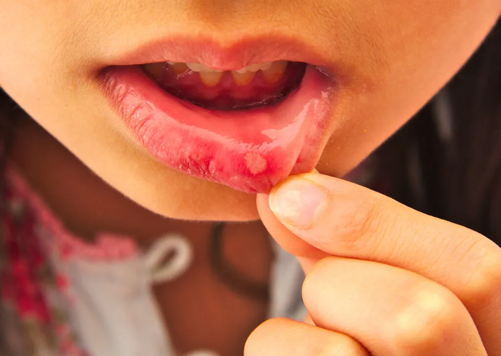 Close-up of a person pulling down their lower lip to reveal a white mouth ulcer or canker sore on the inner lining, surrounded by red irritation.