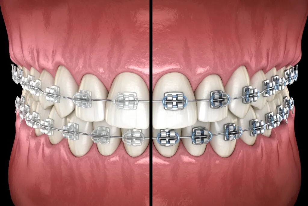 Clear braces versus Metal braces. Medically accurate dental 3D illustration