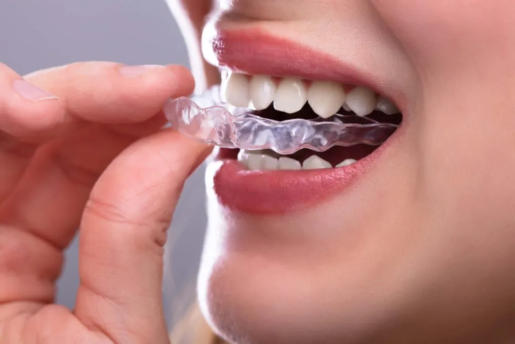 Close up Of A Womans Hand Putting Transparent Aligner In Teeth