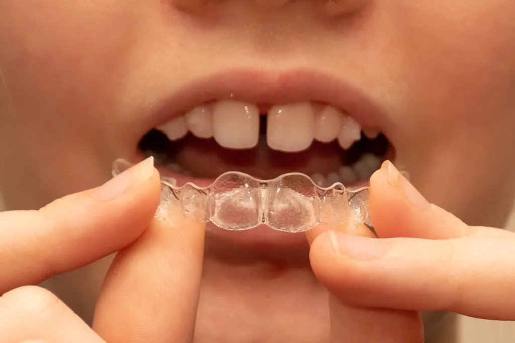Close up of a young woman about to wear invisalign for her large tooth teeth gap