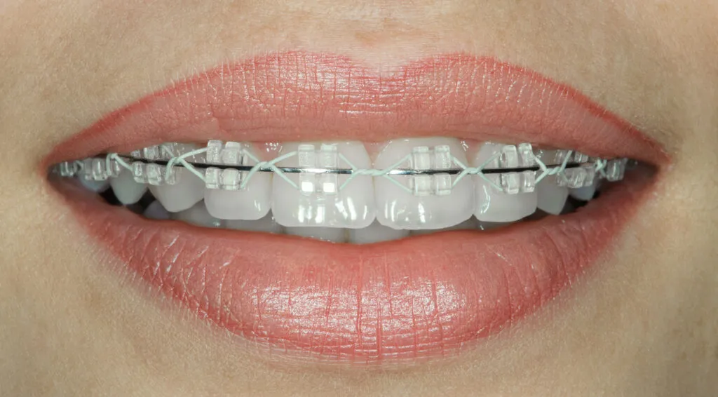 Close up shot of a woman smiling with her power chain braces on