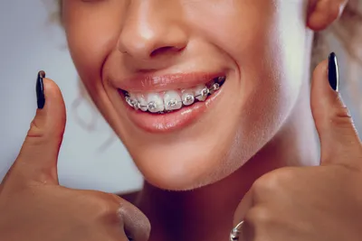 How Long Do Braces Take to Straighten Teeth?