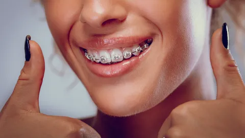 How Long Do Braces Take to Straighten Teeth?