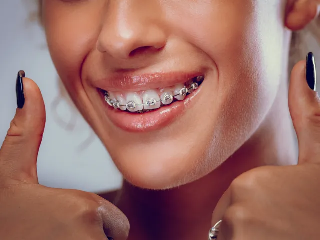 How Long Do Braces Take to Straighten Teeth?