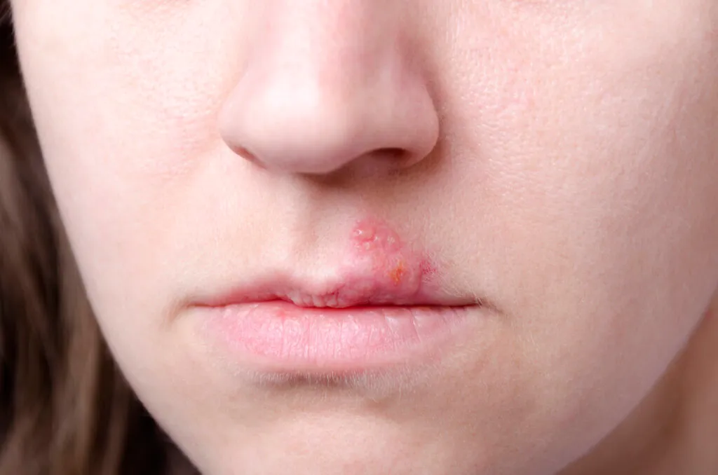 Close-up of a person's lips with a cold sore visible on the upper lip.