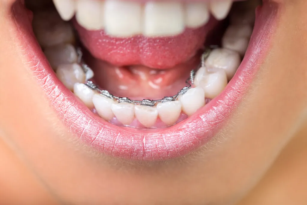 Closeup shot of lingual braces