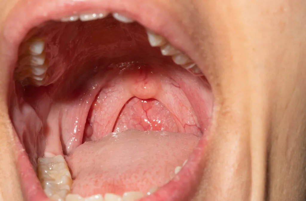 Close-up image of an open mouth showing a clear view of the throat, uvula, teeth, and tongue.