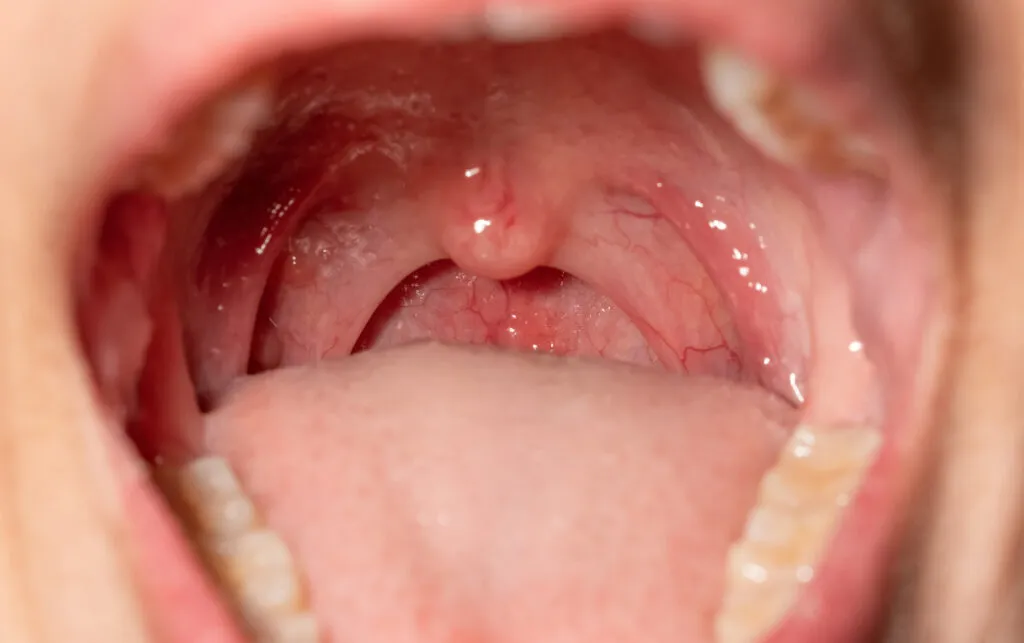 Close-up of an open mouth showing the throat, uvula, and teeth.