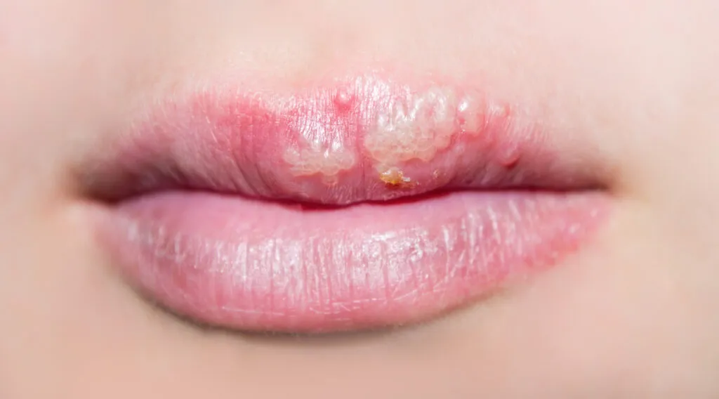 Close-up of lips with a cold sore on the upper lip, showing multiple blisters and redness.