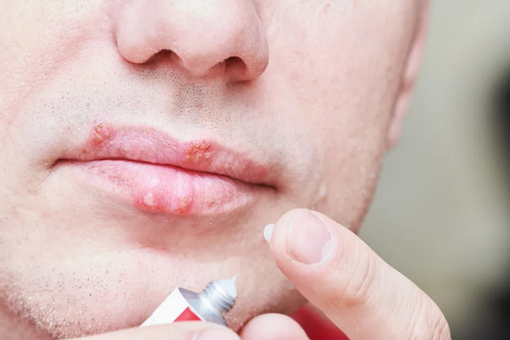 Close-up of a person applying ointment to chapped, inflamed lips with a tube and finger.