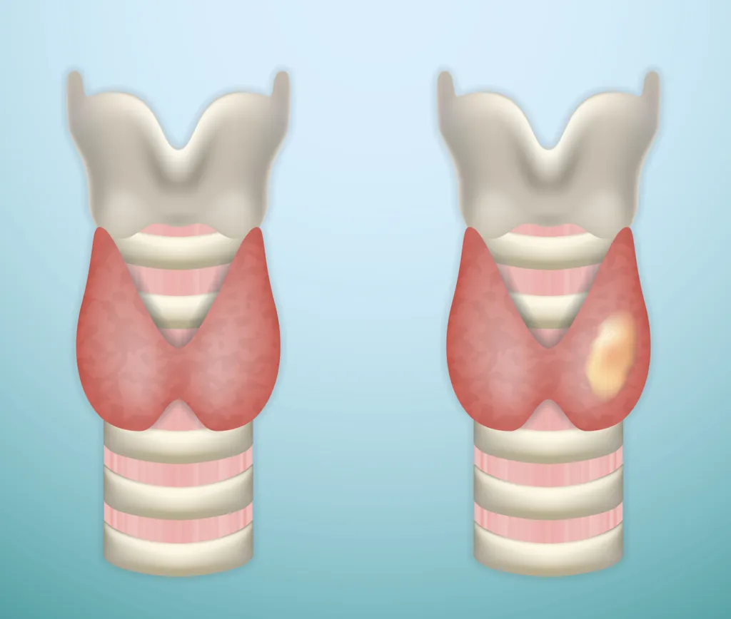 Comparative illustration of a healthy throat vs one with throat cancer 1