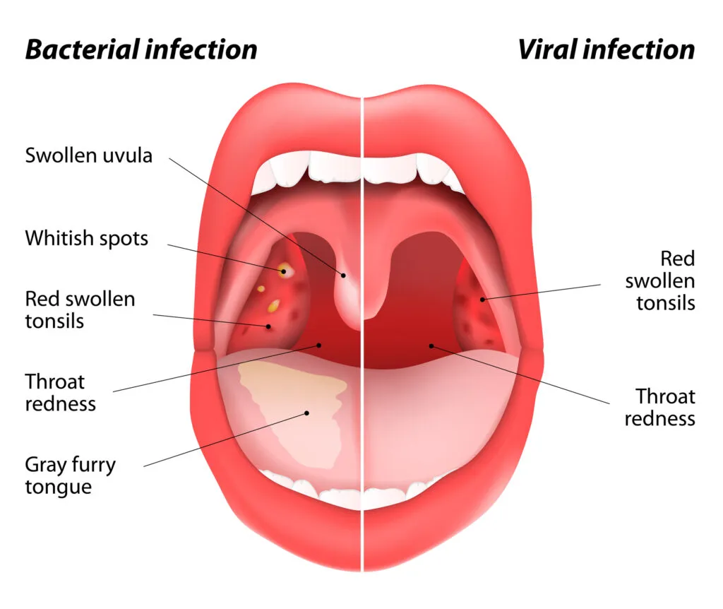 Comparison between bacterial infection and viral infection of the throat illustration