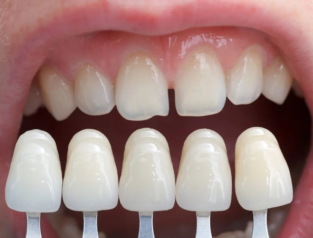 Composite Veneers