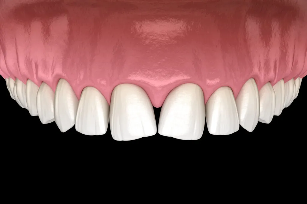 Convergent diastema of central incisors teeth causing black triangle between teeth