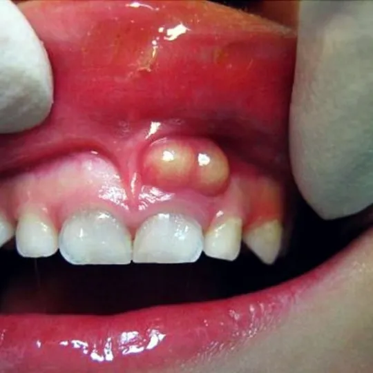 Dental Abscess