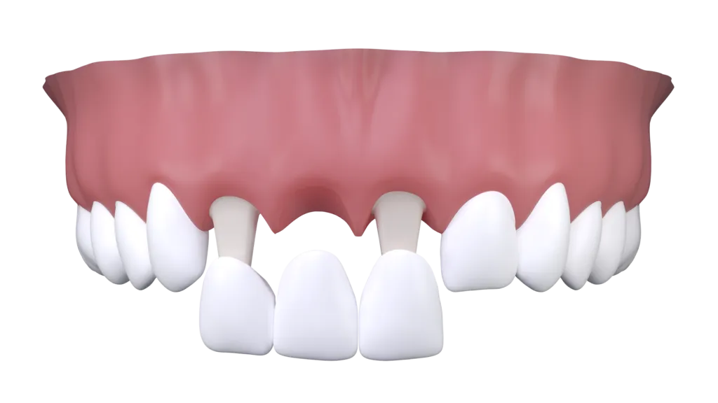 Dental Bridge edited