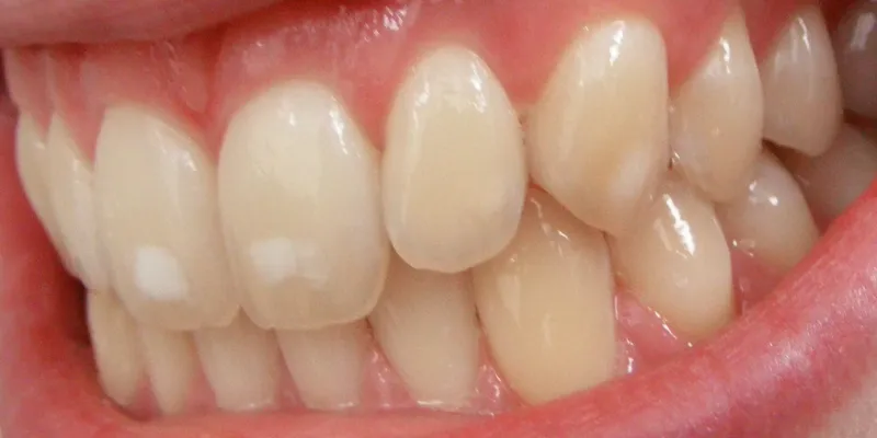Dental Fluorosis 1