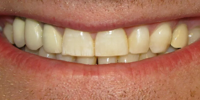 Dental Fluorosis 2