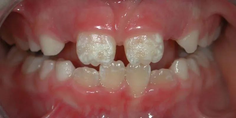 Dental Fluorosis 3