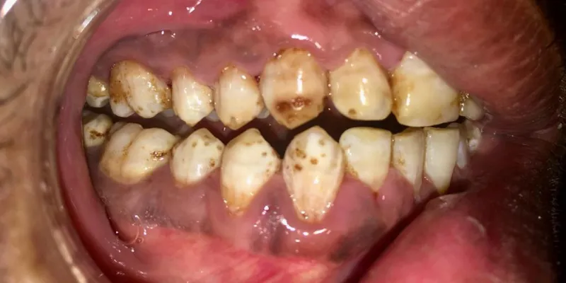 Dental Fluorosis 4
