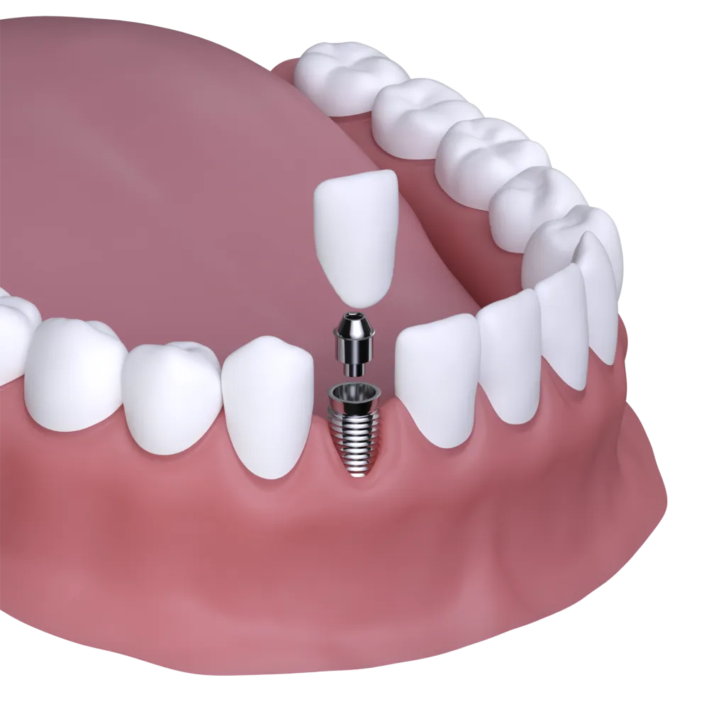 Dental Implant