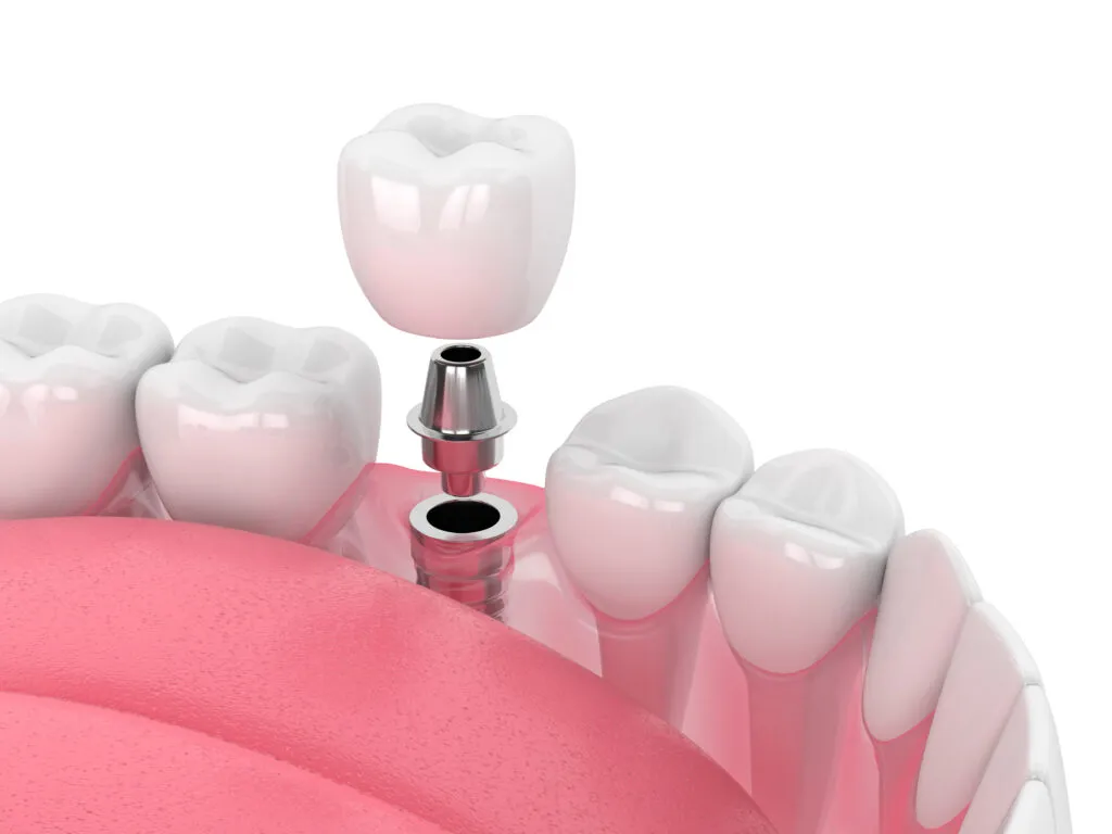 Dental Implants