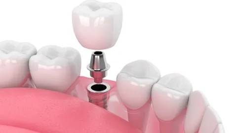 What Is Restorative Dentistry?
