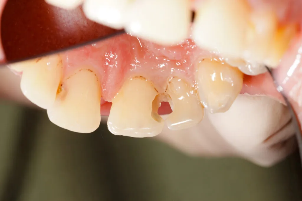 Close-up of decayed teeth with visible cavities and gum issues.
