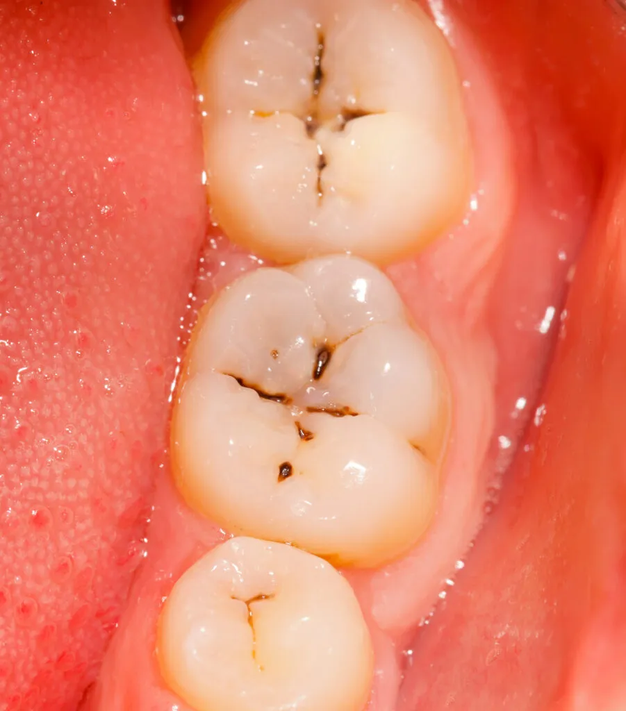 Close-up image of four molars with signs of tooth decay.