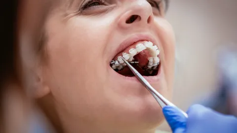 Six Month Smiles Aligners Review (2026)