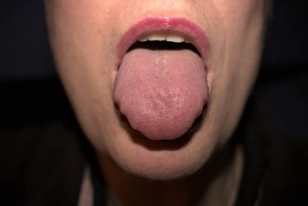 Close-up of a person sticking out their tongue, showing a textured surface against a dark background.