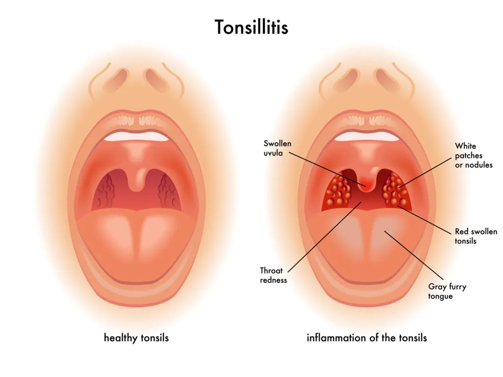 Detailed human Tonsillitis chart