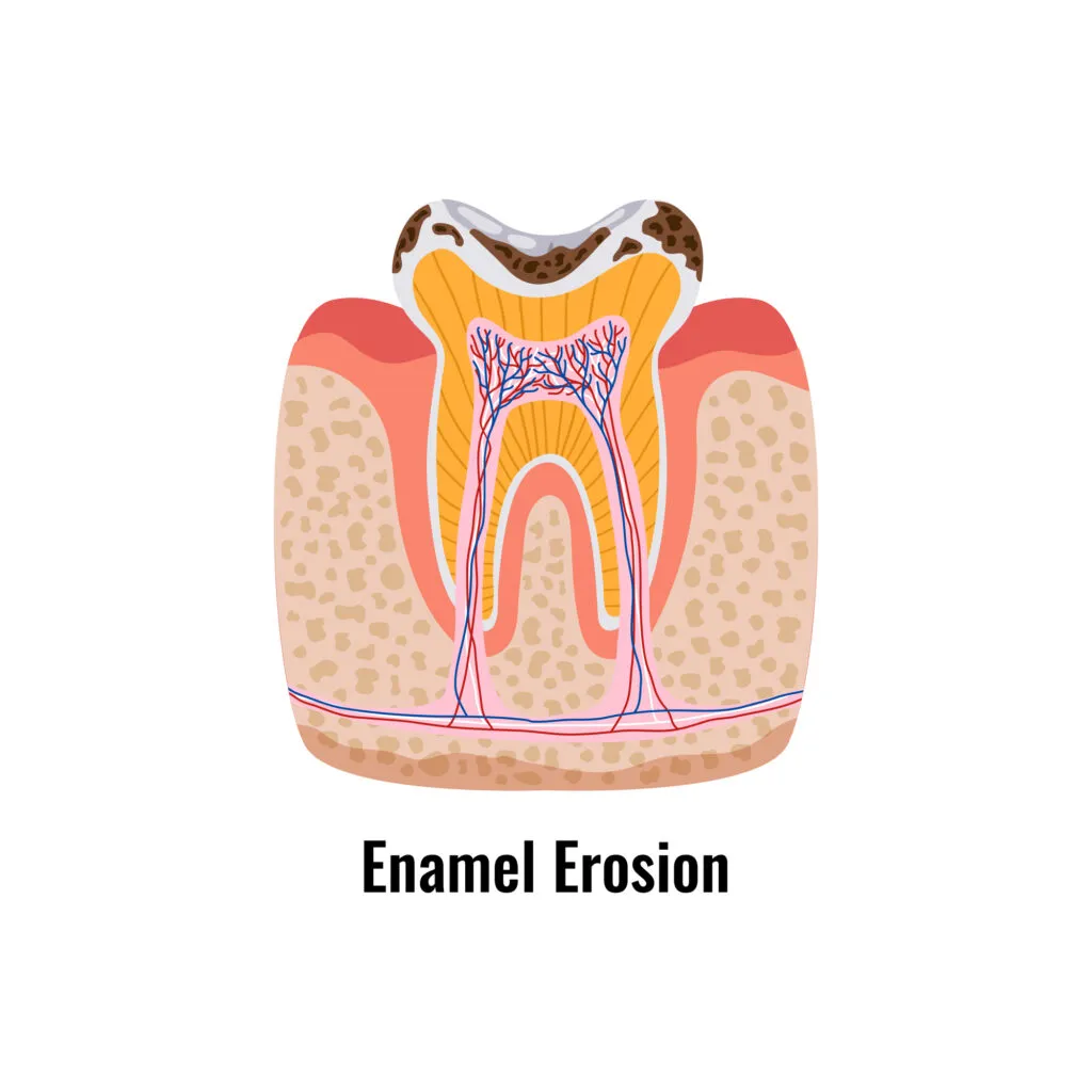 Enamel Erosion illustration