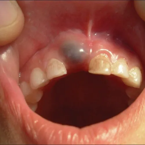 Image of Eruption Cyst