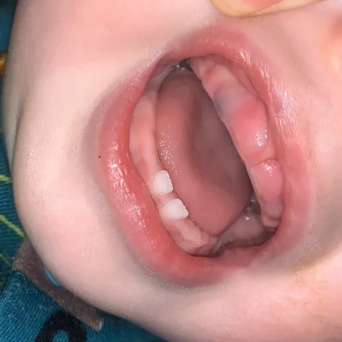 Image of Eruption Cyst