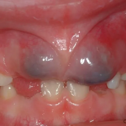 Close-up of upper gums displaying dark bluish lesions above the teeth in the oral cavity.