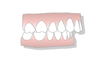 Excessive Overbite Treatment Options