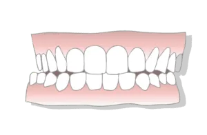 Excessive Overjet Treatment Options