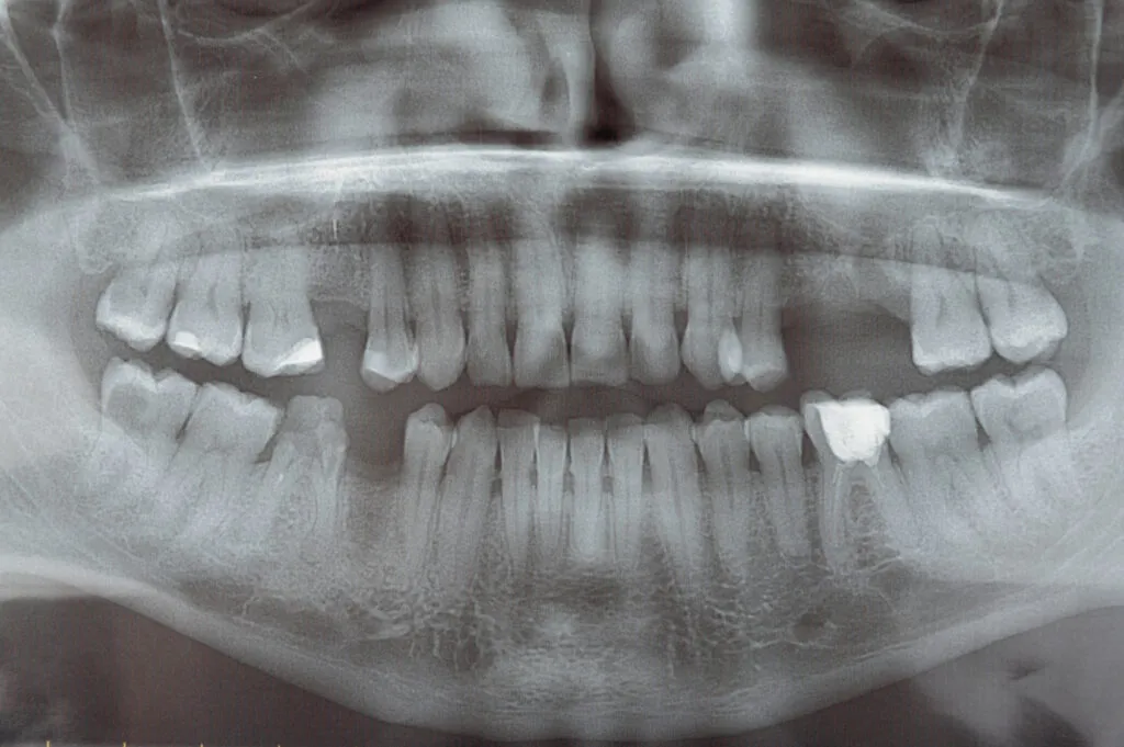 Extraoral panoramic x ray result of teeth