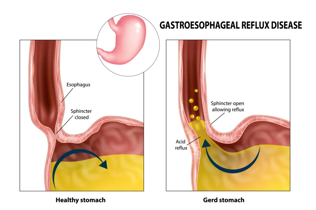 Gastroesophageal reflux disease Gerd or Heartburn illustration comparison vs. a healthy stomach